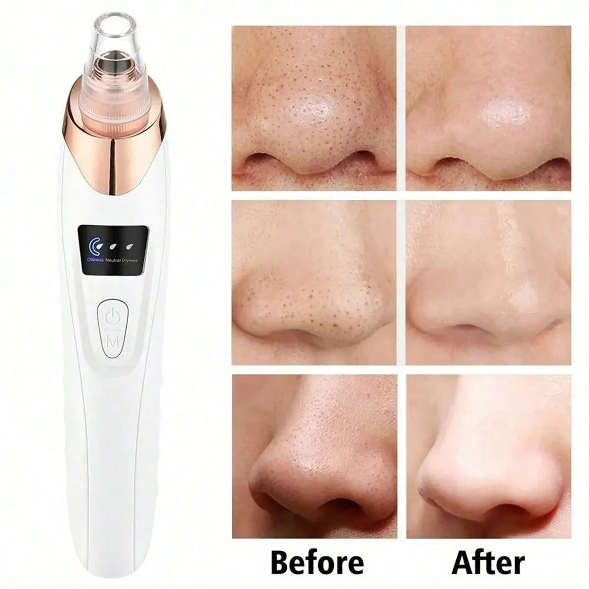 Electric blackhead remover device and before and after nose close-ups showing pore cleaning results