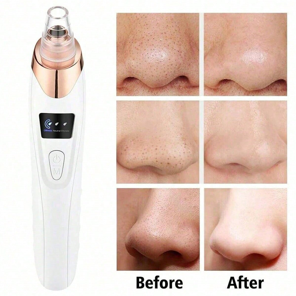 Shopitarium™ Electric Blackhead Remover Vacuum